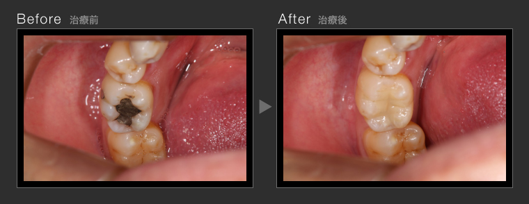 国立デンタルオフィス 治療紹介 虫歯治療 ｃｒ充填法