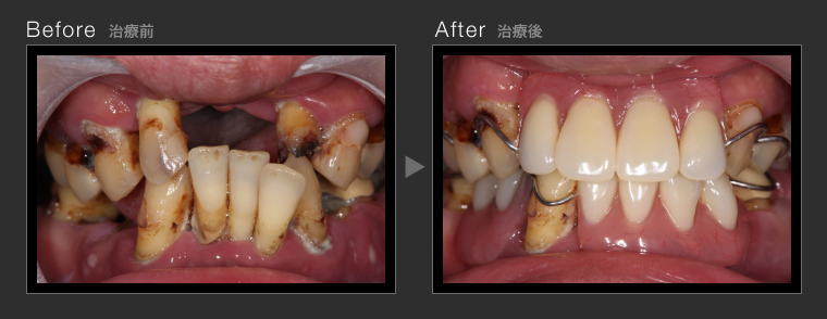 虫歯治療