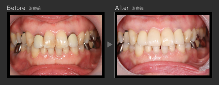 虫歯治療