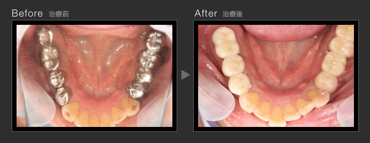 虫歯治療